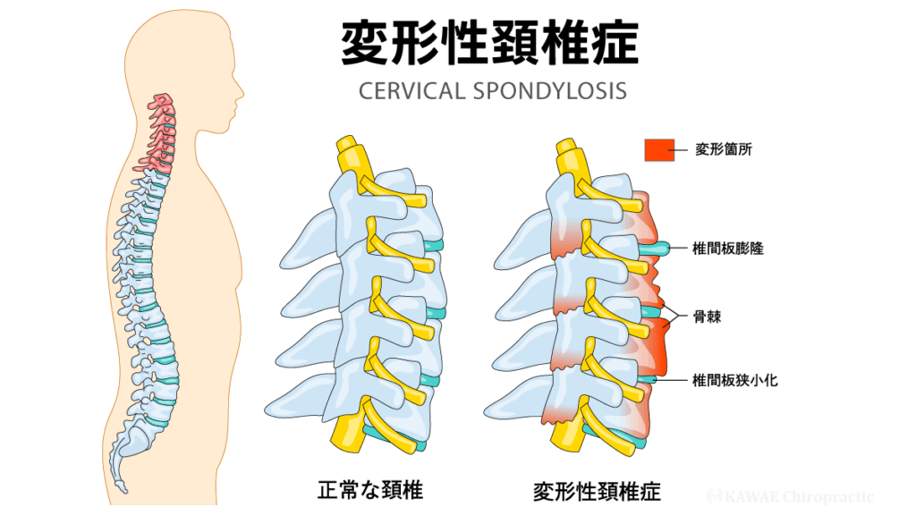 変形性頚椎症