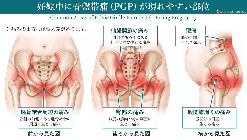 骨盤帯痛の起こりやすい部位