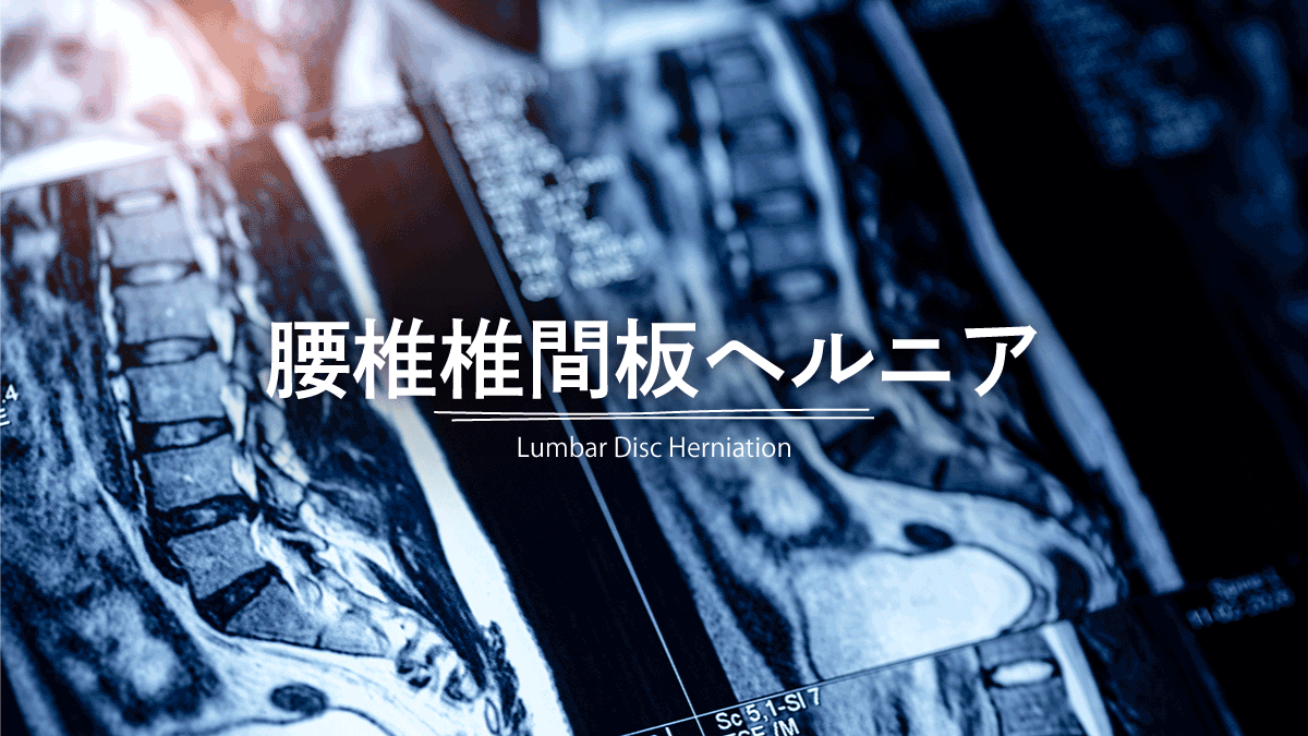 腰椎椎間板ヘルニア